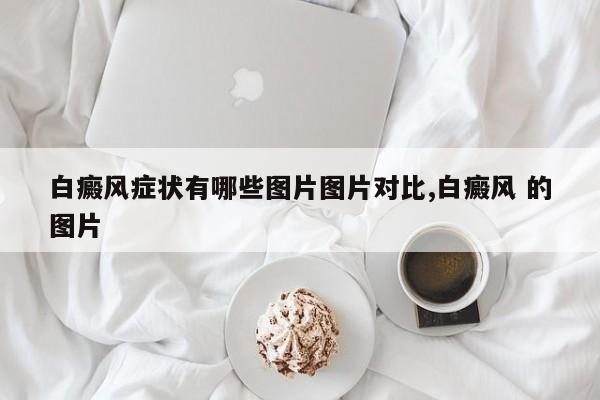 白癜风症状有哪些图片图片对比,白癜风 的图片